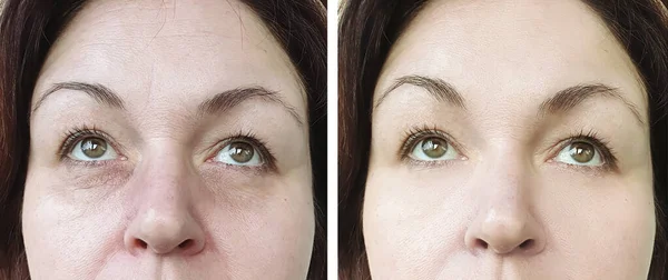 Mulher Rosto Rugas Olhos Antes Depois Tratamento — Fotografia de Stock