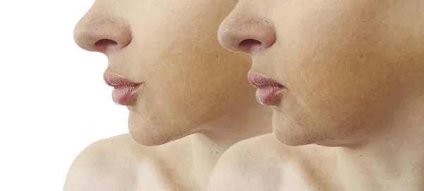Woman Double Chin Treatment — Stock Photo, Image