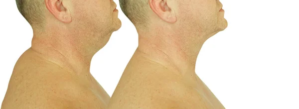 治疗前后男性双下巴 — 图库照片