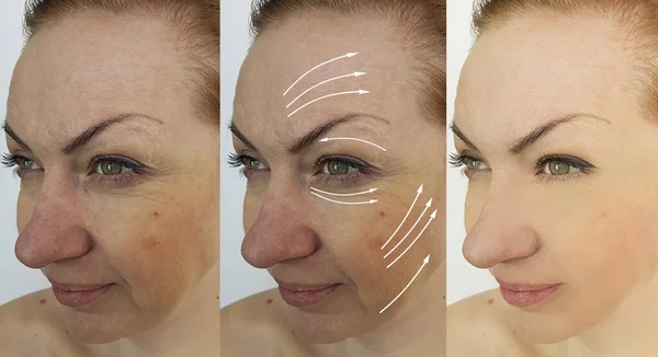 治療前と治療後の女性の顔のしわ矢印 — ストック写真