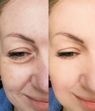 Kadın tedaviden önce ve sonra kırışıklıklarla karşılaşır