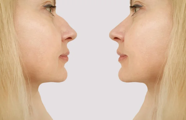 妇女在治疗前和治疗后都会捂住鼻子 — 图库照片