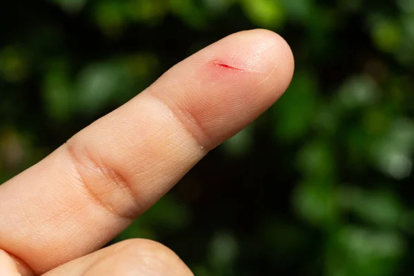 Femeia Fost Tăiată Degetul Arătător Pielea Cicatricilor Îndemână Închidere Macro — Fotografie, imagine de stoc