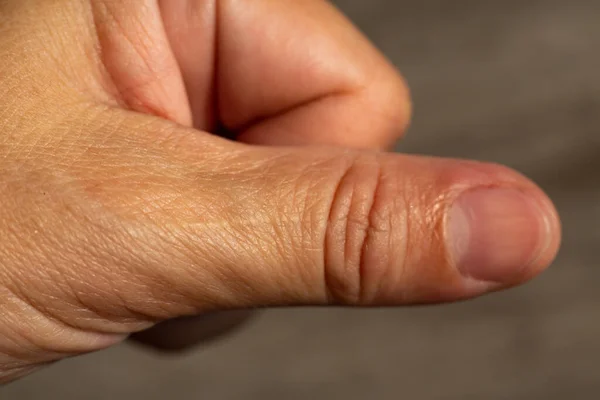 Woman Scar Skin Thumb Hand Close Macro Shot Asian Body — Zdjęcie stockowe