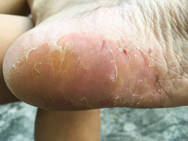 Időskorú Sarok Törés Hámlás Lábak Dermatitise Közelkép Makro Lövés Szelektív — Stock Fotó