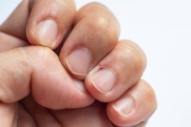 Woman peeled middle finger and wound skin on left hand, White background, Close up & Macro shot, Selective focus, Asian Body skin part, Healthcare concept