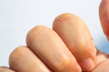 Woman peeled index finger and scar skin on hand, White background, Close up & Macro shot, Asian Body skin part, Healthcare concept