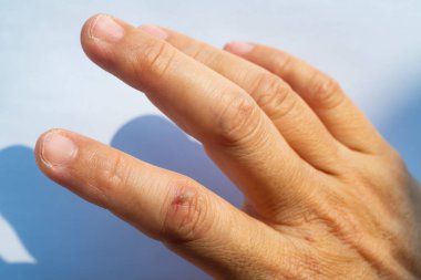 Woman peeled index finger and scar skin on hand, White background, Close up & Macro shot, Asian Body skin part, Healthcare concept