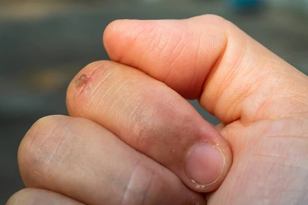 Woman Peeled Index Finger Scar Skin Hand Bokeh Background Close — Φωτογραφία Αρχείου