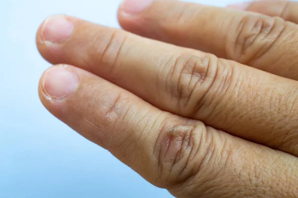 Woman Peeled Index Finger Scar Skin Hand White Background Close — Stock fotografie