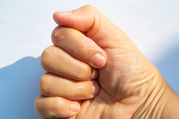 Woman Peeled Index Finger Scar Skin Hand White Background Close — ストック写真