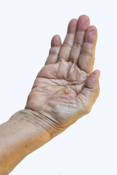 Mujer Mayor Tiene Mano Seca Cáscara Centro Palma Mano Dermatitis — Foto de Stock