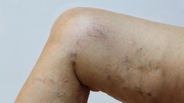 Varices Sur Une Jambe Chez Les Femmes Âgées Fond Blanc — Video