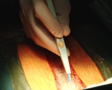 Benzersiz kalp ameliyatı yapılan ilk kez