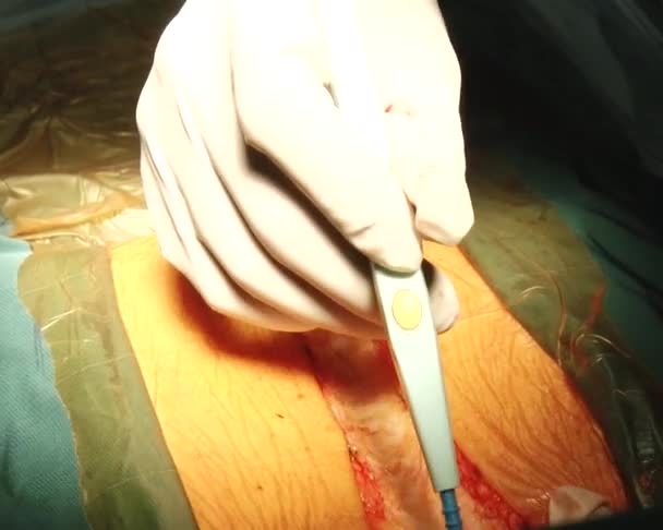 Unikátní kardiochirurgie poprvé provedena — Stock video