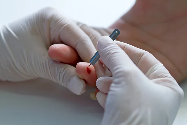 Hand des Arztes und weißer Handschuh zeigen Bluttest per Blutlanze — Stockfoto