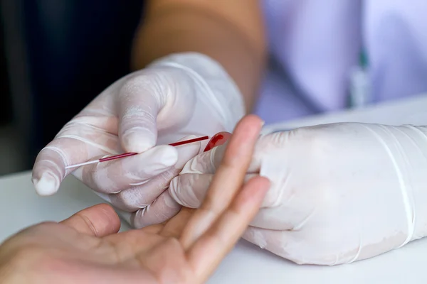 Mano del médico y guante blanco muestran análisis de sangre por tubo capilar Imagen De Stock
