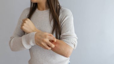 Sağlık alerjisi cilt bakımı sorunu. Kolunu alerji isiliği ile kaşıyan genç bir kadın. Kaşınan bir kadın. Hassas cilt, besin alerjisi semptomları, tahriş.