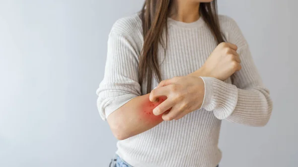 Alergia Saúde Problema Cuidados Pele Feche Jovem Mulher Coçando Braço — Fotografia de Stock