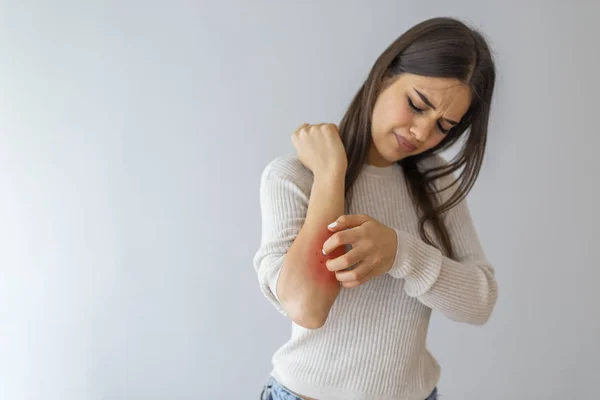 健康上の問題皮膚病 若い女性はアレルギー性発疹で彼女のかゆみの腕を引っかきます 女が腕を掻いてた 女性は屋内で テキストのためのスペース腕を掻く アレルギー症状 — ストック写真