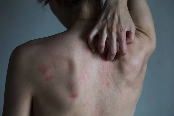 Scratches on a back. — Stock Photo, Image