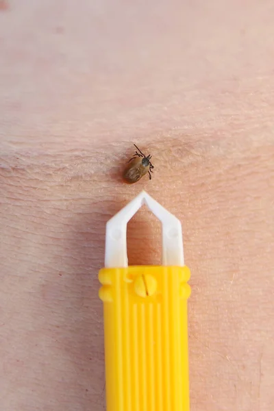 Tick Feeding Persons Arm Being Removed Pincet Tweezer Royalty Free Stock Images