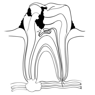  Diş kırdı ve çürük anatomi, tıbbi kavramı-vektör Illustra