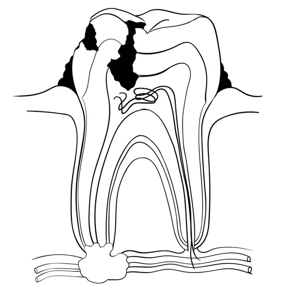 Diente roto y caries anatomía, concepto médico-Vector Illustra — Archivo Imágenes Vectoriales