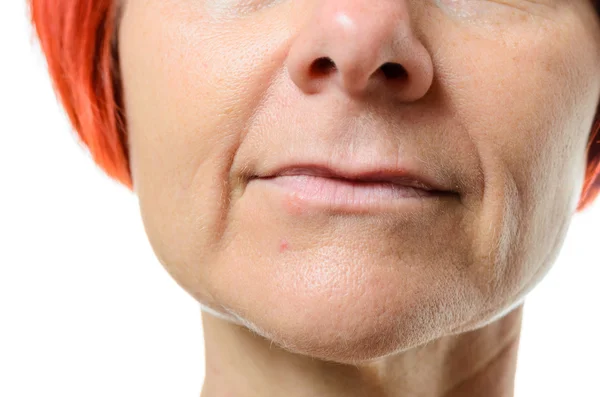 Woman with blemish on chin — Stock Photo, Image