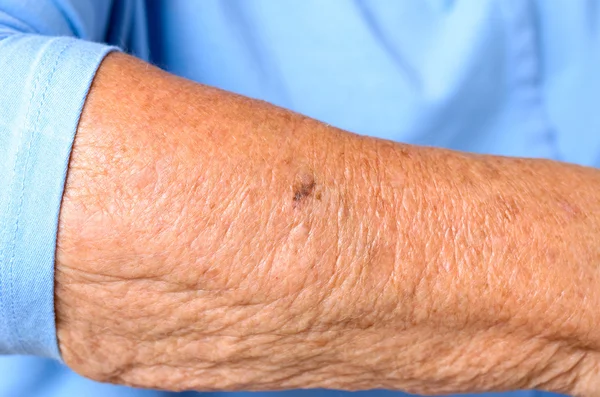 Close up detail of the forearm of an elderly woman — Stock Photo, Image