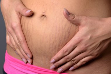 Woman showing stretch marks on her lower abdomen clipart