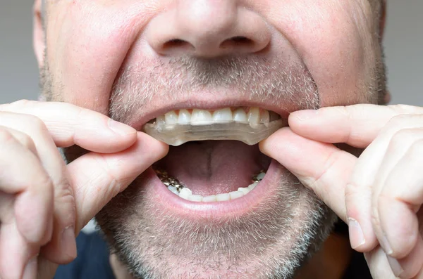 Man placing a bite plate in his mouth — Stock Photo, Image