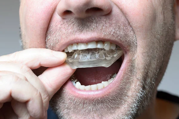 Man placing a bite plate in his mouth — Stock Photo, Image