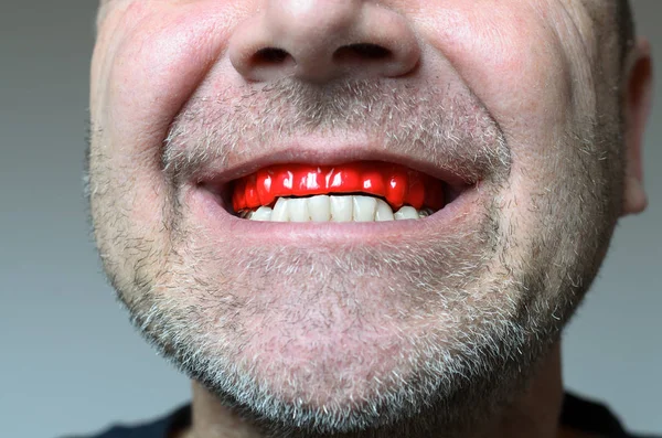 Homme mordant sur une plaque de morsure dans sa bouche — Photo