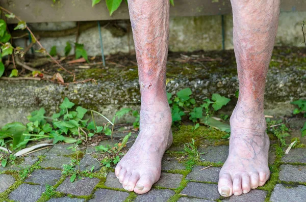 Leg of an old person with circulatory problems