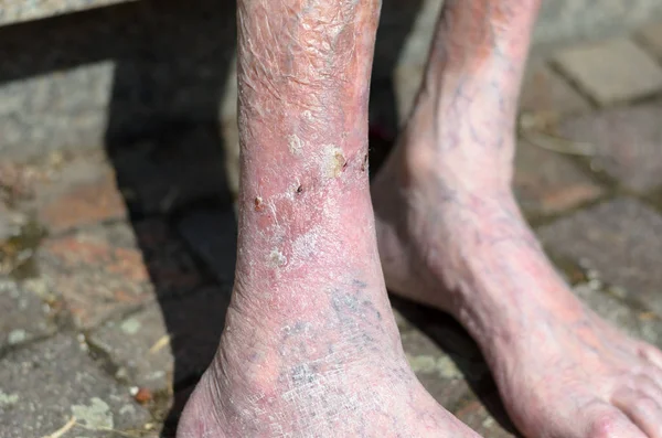 Нога пожилого человека с проблемами кровообращения — стоковое фото