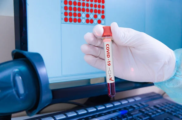 Positive test for Covid-19. An infected Covid-19 sample in a test tube with a label in the doctor\'s hand. Laboratory tube with SARS-CoV2. Laboratory Coronavirus Test.