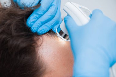 Saç ve kafa derisinin üç kopyasıyla yakından incelenmesi. Trikop bir doktorun elinde.