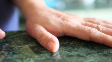 Sedef veya zona hastalığı ile el. Cilt sorunları.