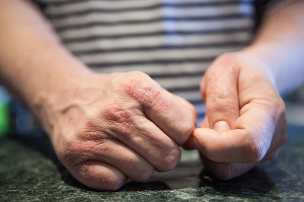 Manos con psoriasis o eczema. Problemas de salud con la piel . — Foto de Stock