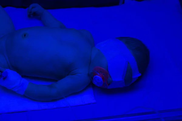 Неонатальная желтуха. Новорожденного лечила фототерапия. Голубая лига — стоковое фото