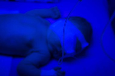 Kimliği belirsiz yeni doğan bebek sarılık için UV fototerapi alma