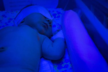 Ultravi altında sarılık tedavisinde sahip yeni doğan çocuk bebek
