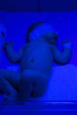 Kimliği belirsiz yeni doğan bebek sarılık için UV fototerapi alma