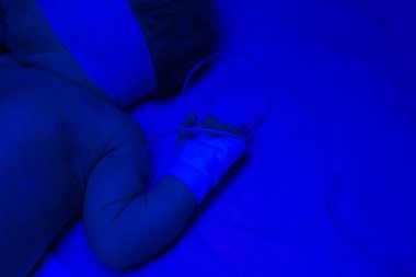 Kimliği belirsiz yeni doğan bebek sarılık için UV fototerapi alma