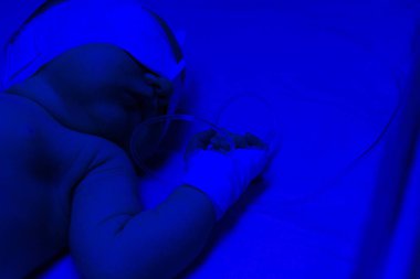 Yenidoğan sarılığı. Yeni doğan fototerapi tarafından tedavi edildi. Mavi lig