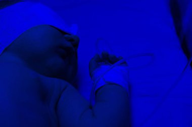 Yenidoğan sarılığı. Yeni doğan fototerapi tarafından tedavi edildi. Mavi lig