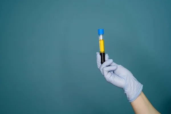 Hand Mädchen Arzthandschuh hält Reagenzglas mit Blutplasma — Stockfoto