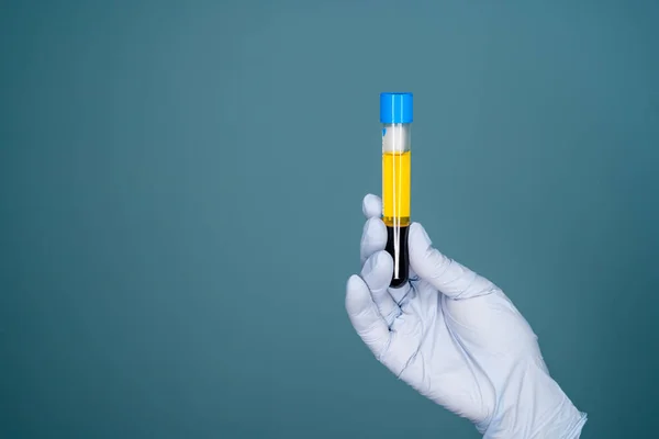 Blood plasma in vitro gloved hand holding — Stockfoto