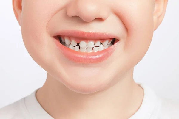 Aralarındaki boşluklarla birlikte süt dişlerine yakın çekim. Diaeresis, diastema tedavisi konsepti. Diş problemi.